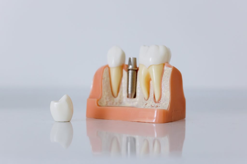 Comment payer moins cher son implant dentaire ? Comment payer moins cher son implant dentaire ?