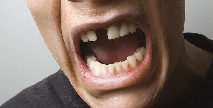 Que faire en cas de perte de dents ?